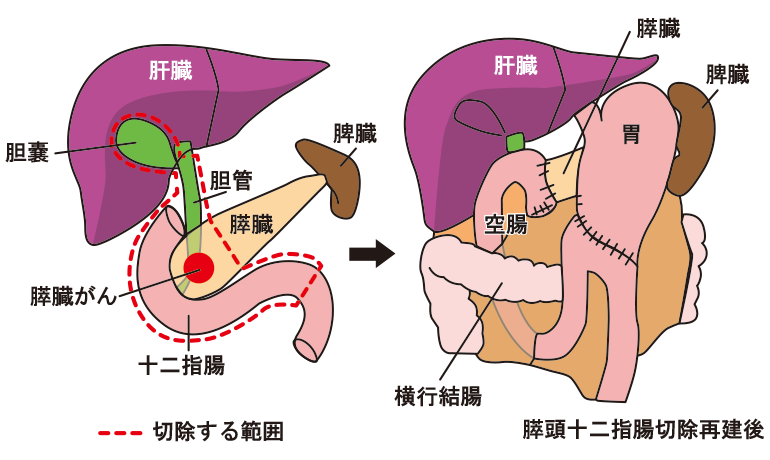 膵頭十二指腸切除臓器手作りキーホルダー看護