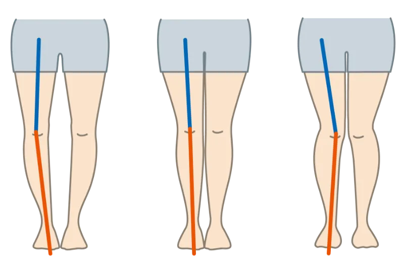 下肢アライメント