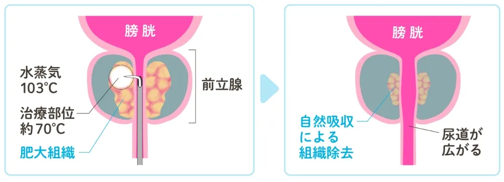 経尿道的水蒸気治療（WAVE治療